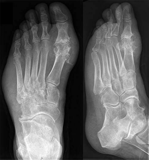 Exemple de gota radiografia peu esquerrà imatge